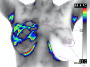 infraredmed-exame-mamografia-infravermelho